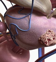 disease story