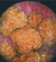 disease story